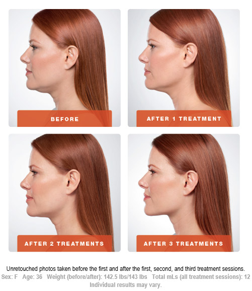 Kybella Treatment Before and After 1 Art of Natural Beauty Center