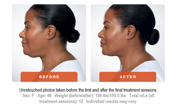 Kybella Treatment Before and After 3 Art of Natural Beauty Center
