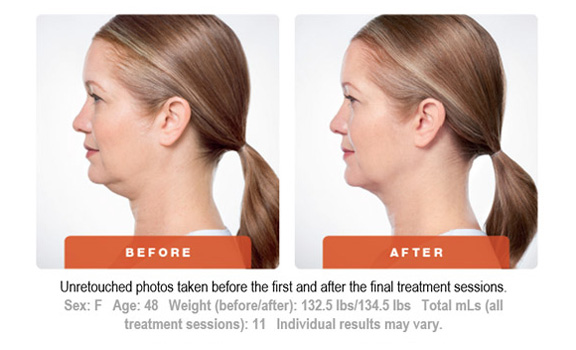 Kybella Treatment Before and After 4 Art of Natural Beauty Center