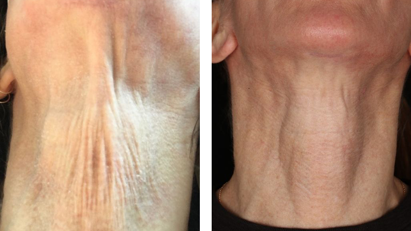 Before and After Treatment Images of Renuva Injections 002