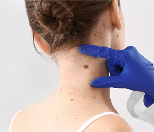 Discover PicoWay Laser Pigmentation Removal