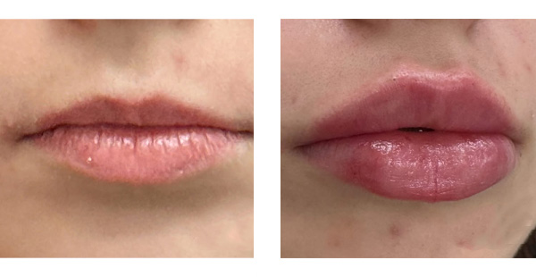 Lip Filler